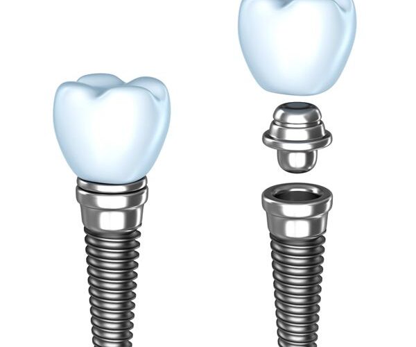 Dental implant