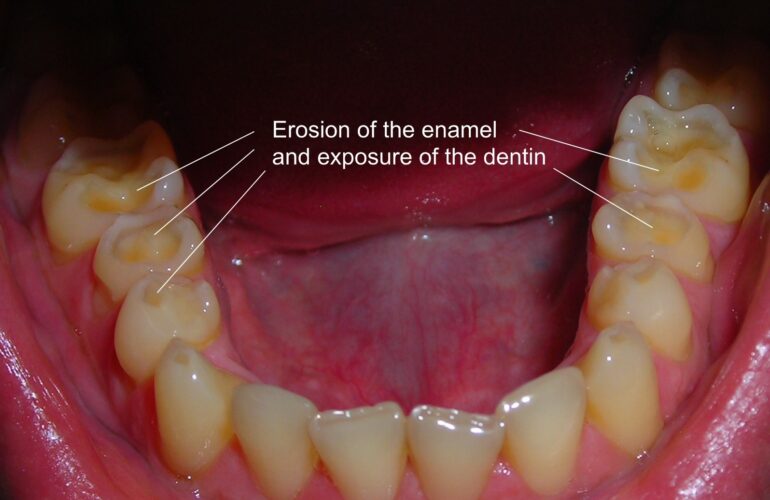 Enamel Erosion