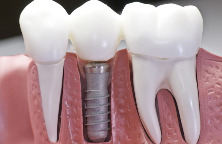 dental implants