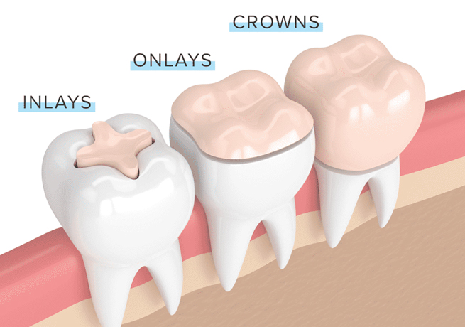 Inlays and Onlays