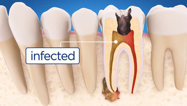 What-is-Root-Canal-Treatment