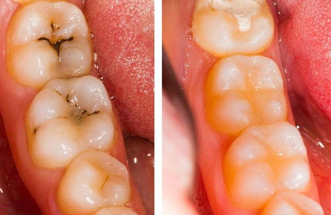 fillings-1