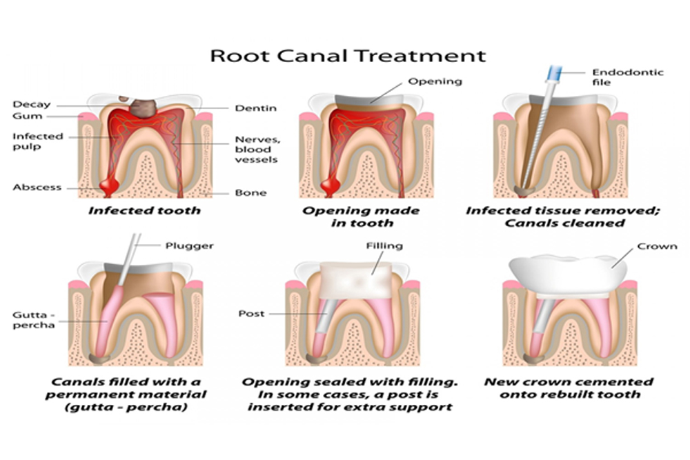 root canal treatment