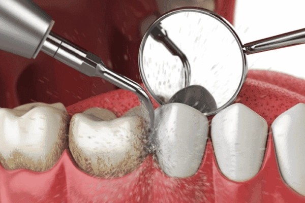teeth-cleaning1