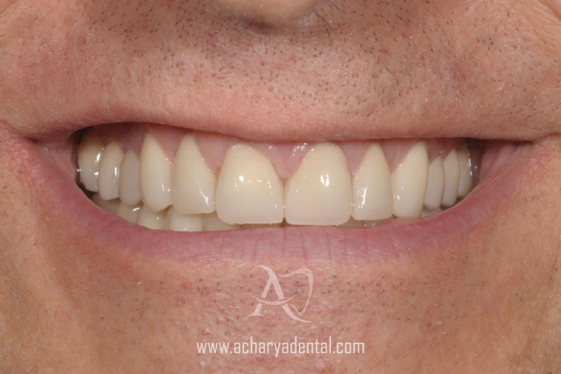 Smile-Makeovers