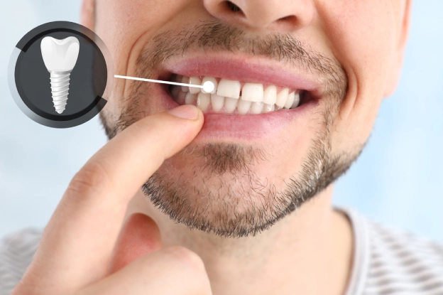 dental-implants-step3